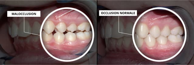 MALOCCLUSION