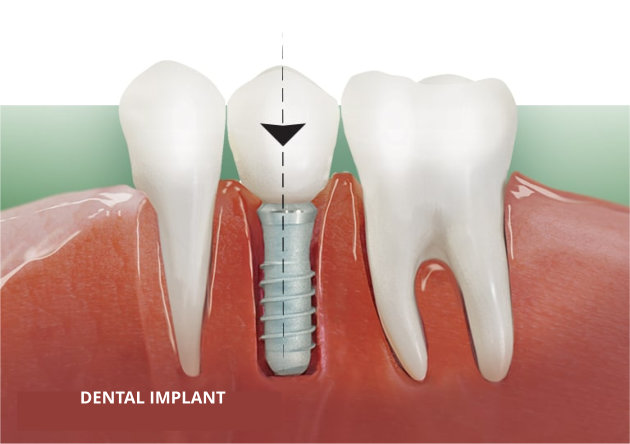 DENTAL IMPLANT