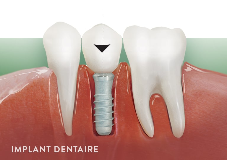 Implant dentaire