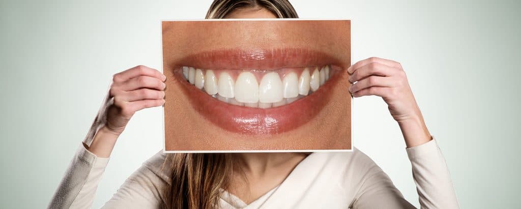 facettes dentaires cosmétiques