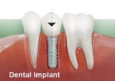 dental implant - Spa dentaire Laurier