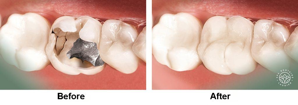 dental crown - Spa dentaire Laurier