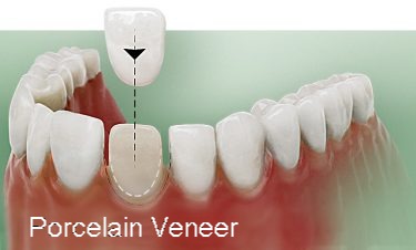 porcelain veneer