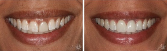 dental veneers - before and after